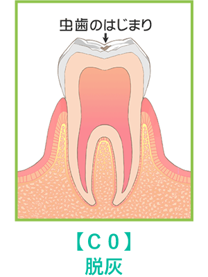 虫歯のはじまり