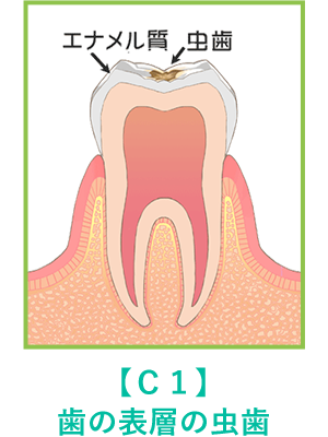 歯の表層の虫歯