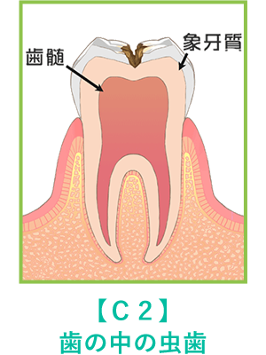 歯の中の虫歯