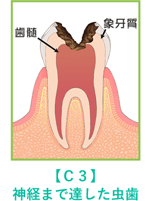 神経まで達した虫歯