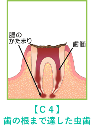 歯の根まで達した虫歯