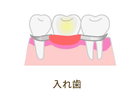 入れ歯