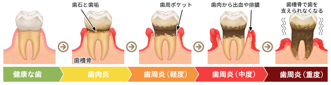 歯周病の進行