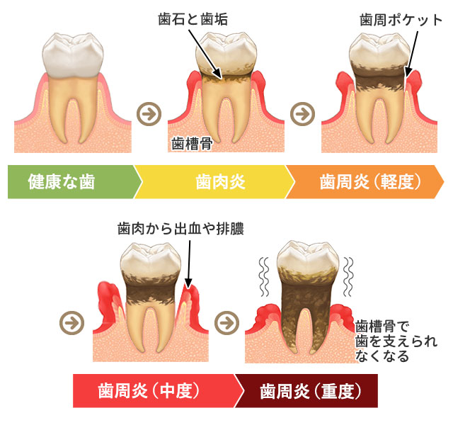 歯周病の進行