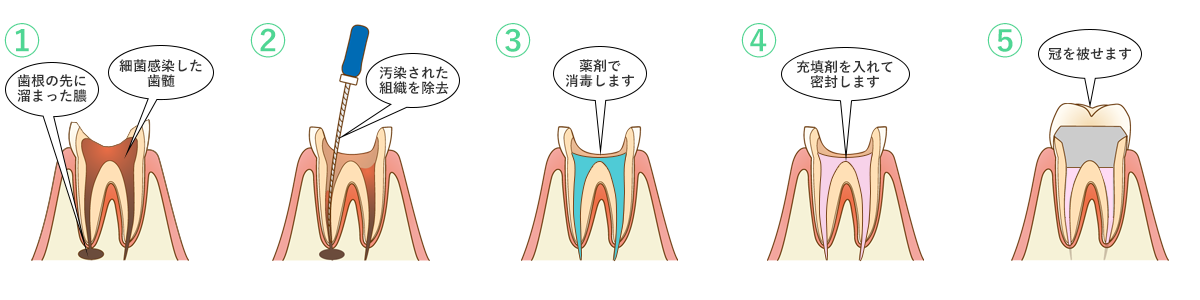 根管治療