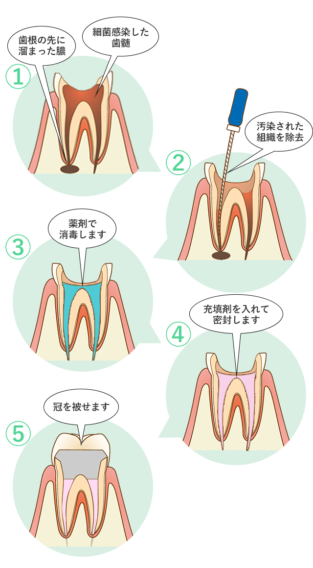 根管治療