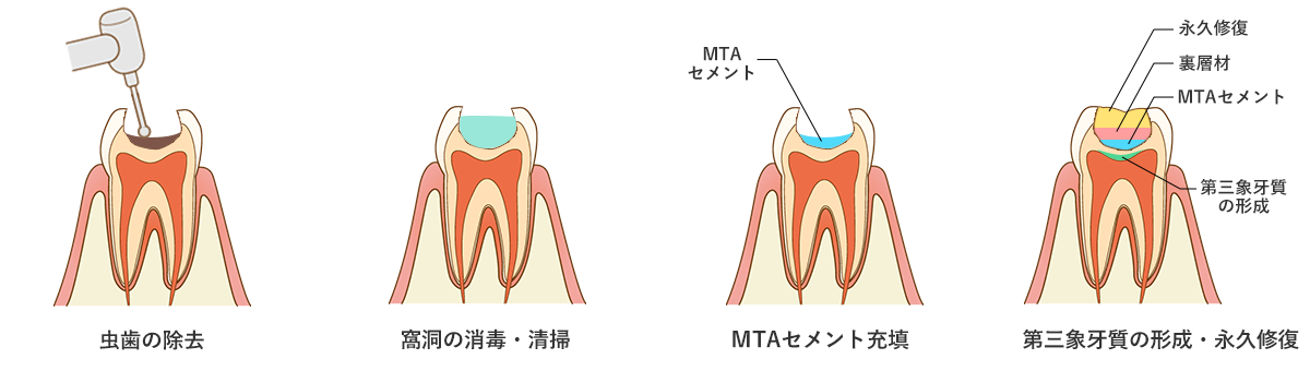 間接覆髄法