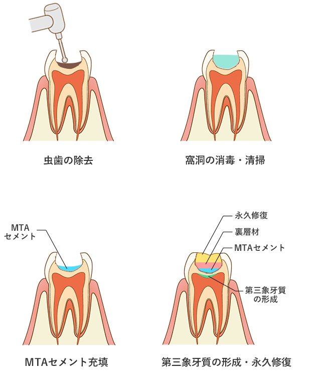 間接覆髄法