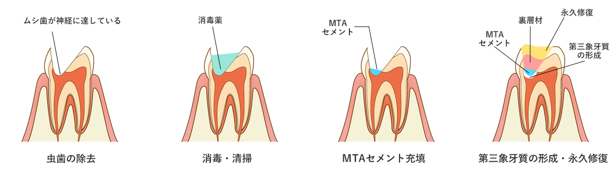 直接覆髄法