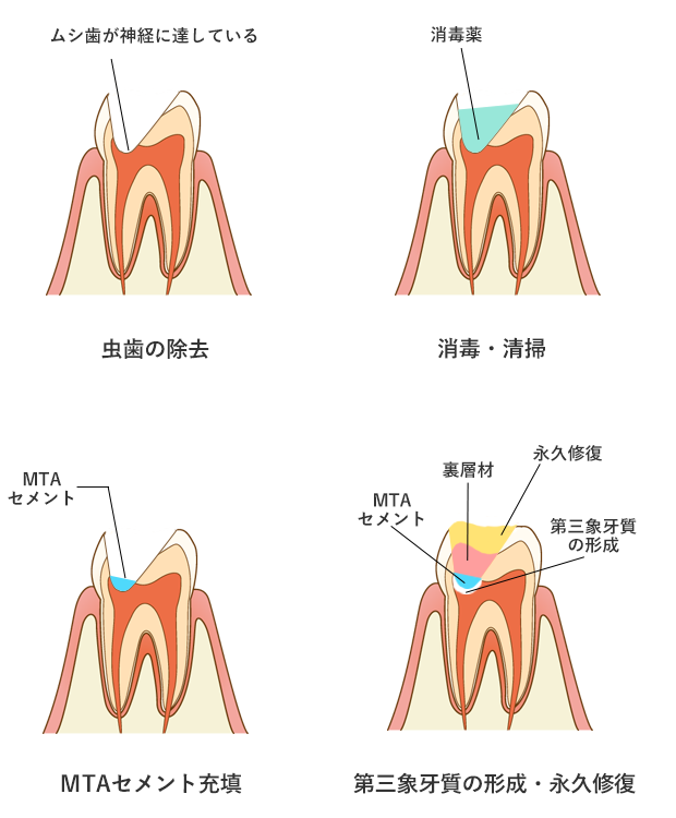 直接覆髄法