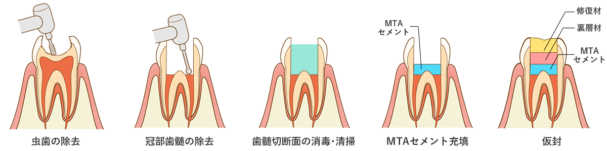 生活断髄法