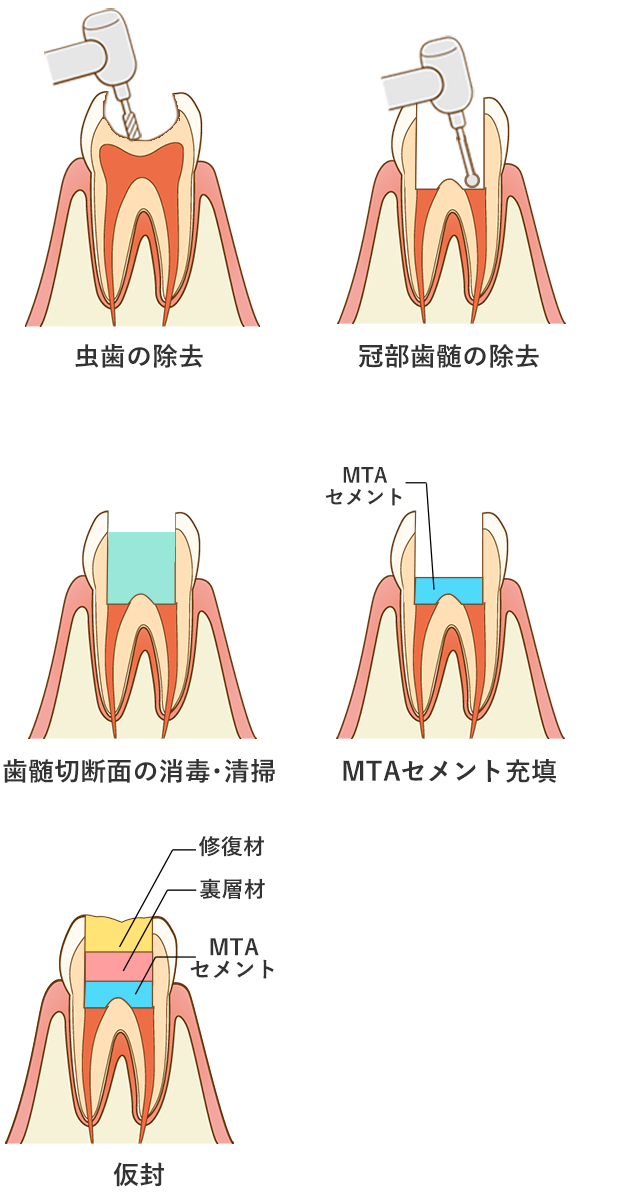 生活断髄法